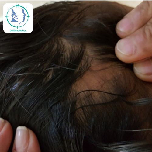 alopecia areata 2 dermohs tratamiento alopecia areata 2 dermohs tratamiento