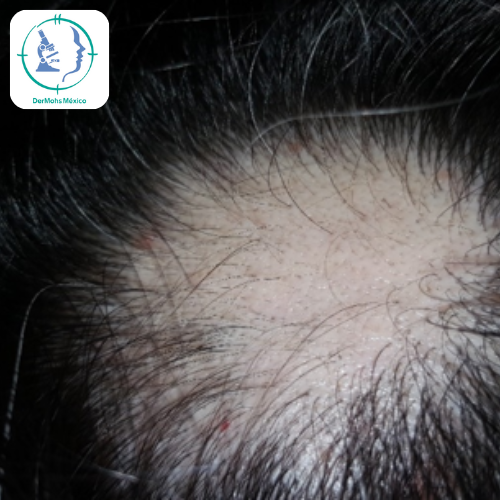 alopecia areata 3 dermohs tratamiento alopecia areata 3 dermohs tratamiento