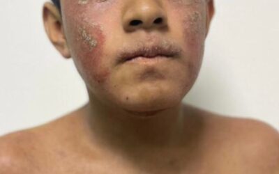¿Qué es la dermatitis atópica, por qué aparece y cómo tratarla en CDMX?