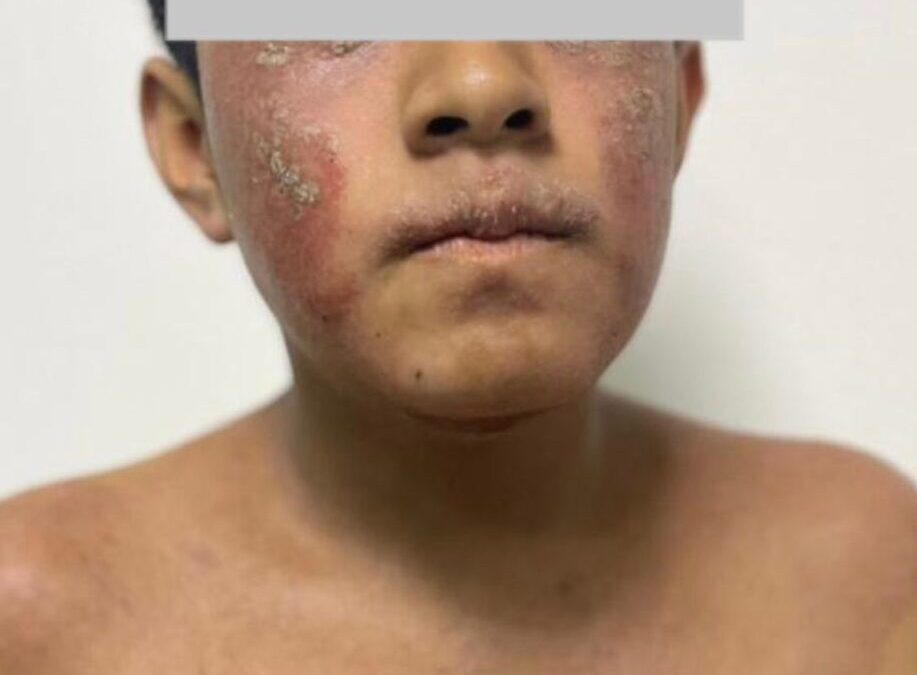 ¿Qué es la dermatitis atópica, por qué aparece y cómo tratarla en CDMX?